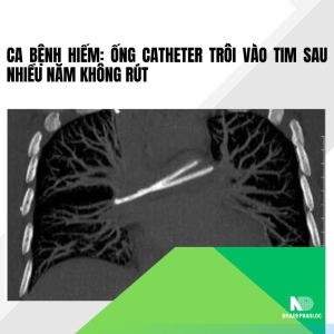 Ca bệnh hiếm: Ống catheter trôi vào tim sau nhiều năm không rút